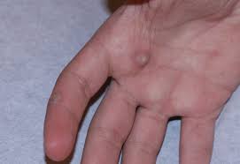 what are warts and wart treatments