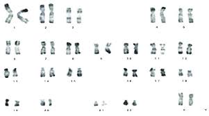 Karyotype Of A Patient With Male Syndrome 46 Xx Download