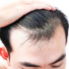 stress and hair loss cosca clinic