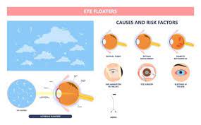 eye floaters causes how to get rid