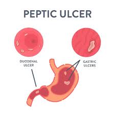 peptic ulcer disease in singapore