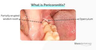 pericoronitis smell share dental care