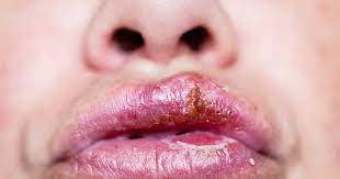 Is It Possible to Get Genital Herpes from Oral Herpes?