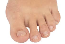 when does an ingrown toenail require a