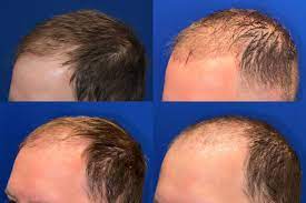 fue shock loss after hair transplants