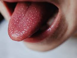 healthy tongue pictures conditions