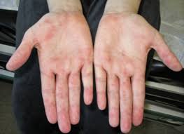 Palmar erythema is a type of skin problem that is only limited at the palms but this incident can also mean that there might be other. Pediatric Systemic Lupus Erythematosus American Academy Of Pediatrics