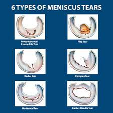 meniscus tears florida orthopaedic