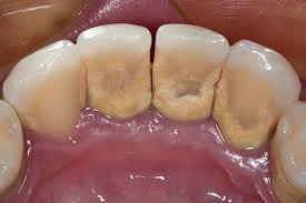 is gum disease curable here s what to