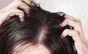 The hair will become weak, brittle, and lifeless. Can Dandruff Cause Hair Loss How To Treat It Vedix