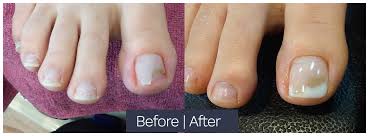 resin gel treatment nail county singapore