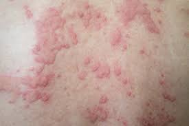 are hives a symptom of hiv