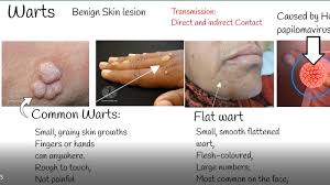warts causes and treatment wart types
