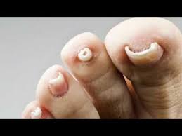 how excilor fungal nail treatment works