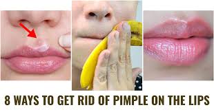 get rid of a pimple on your lips