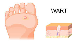 how to get rid of plantar warts in most