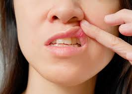 mouth sores after dental work dentist