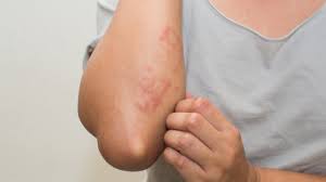 common skin rashes and what to do about