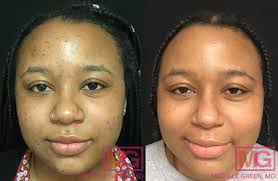 african american skin treatment