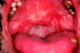 mouth ulcers and other causes of
