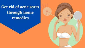 acne scars naturally