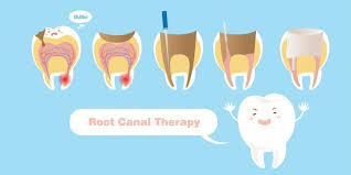 Eat on the opposite side of the treatment, that is, the side that is not numb. Eating After Root Canal Therapy Marsfield Dental Care