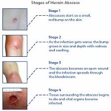 what is a abscess ask our
