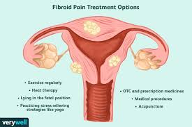 how fibroid pain is treated
