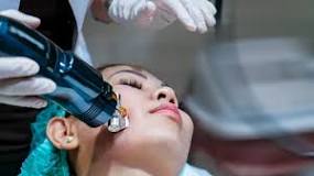 Radiofrequency Microneedling: Procedure, Aftercare, Side ...