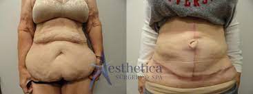 tummy tuck before after photos