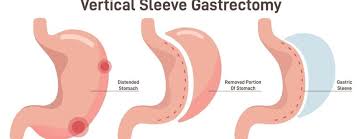 gastric sleeve cost more explained by