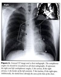 What is apico lordotic means. Chest Radiography For Radiologic Technologists Document Gale Academic Onefile