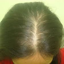 grade iii hair loss in a female patient