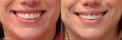 botox lip flips before after photos