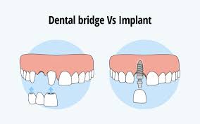 dental extraction bridges vs implants