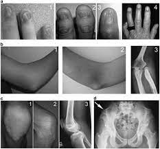 nail patella syndrome clinical and