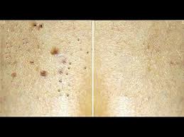 dark spot removal home remedy for