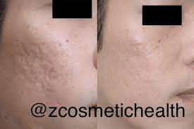 acne scar treatments z cosmetic