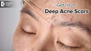 7 ways to get rid of pitted acne scars