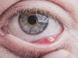 Use a strong steady stream of clean water. Internal Stye Definition Symptoms Causes And Treatment