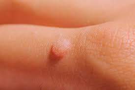 myths and facts about warts