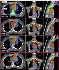proton therapy for astinal lymphoma