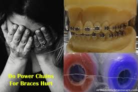 How to stop braces from cutting your mouth inside. Do Power Chains For Braces Hurt 8 Tips For Pain Relief Orthodontic Braces Care