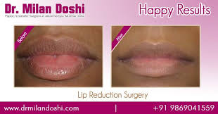 lip reduction before after results dr