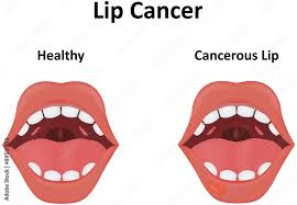 lip cancer ilration stock vector