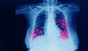 Instead, most lung cancers are diagnosed in the late stages of the disease, making treatment more problematic and as a result significantly reducing the overall lung cancer survival rate. Can You Have Cancer For Years And Not Know It Lung Cancer Pintas Mullins Law Firm