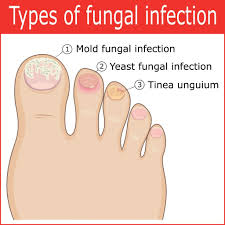 cure pain from toenail fungus infection