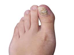 top 3 proven fungus toenail treatment