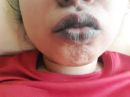 what causes lip hyperpigmentation human