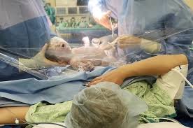 baby being born during a c section